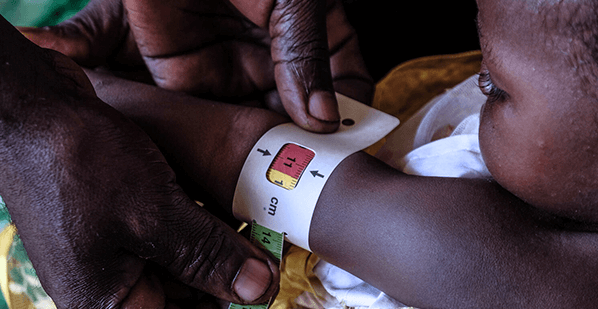 Fotografía de niño con desnutrición